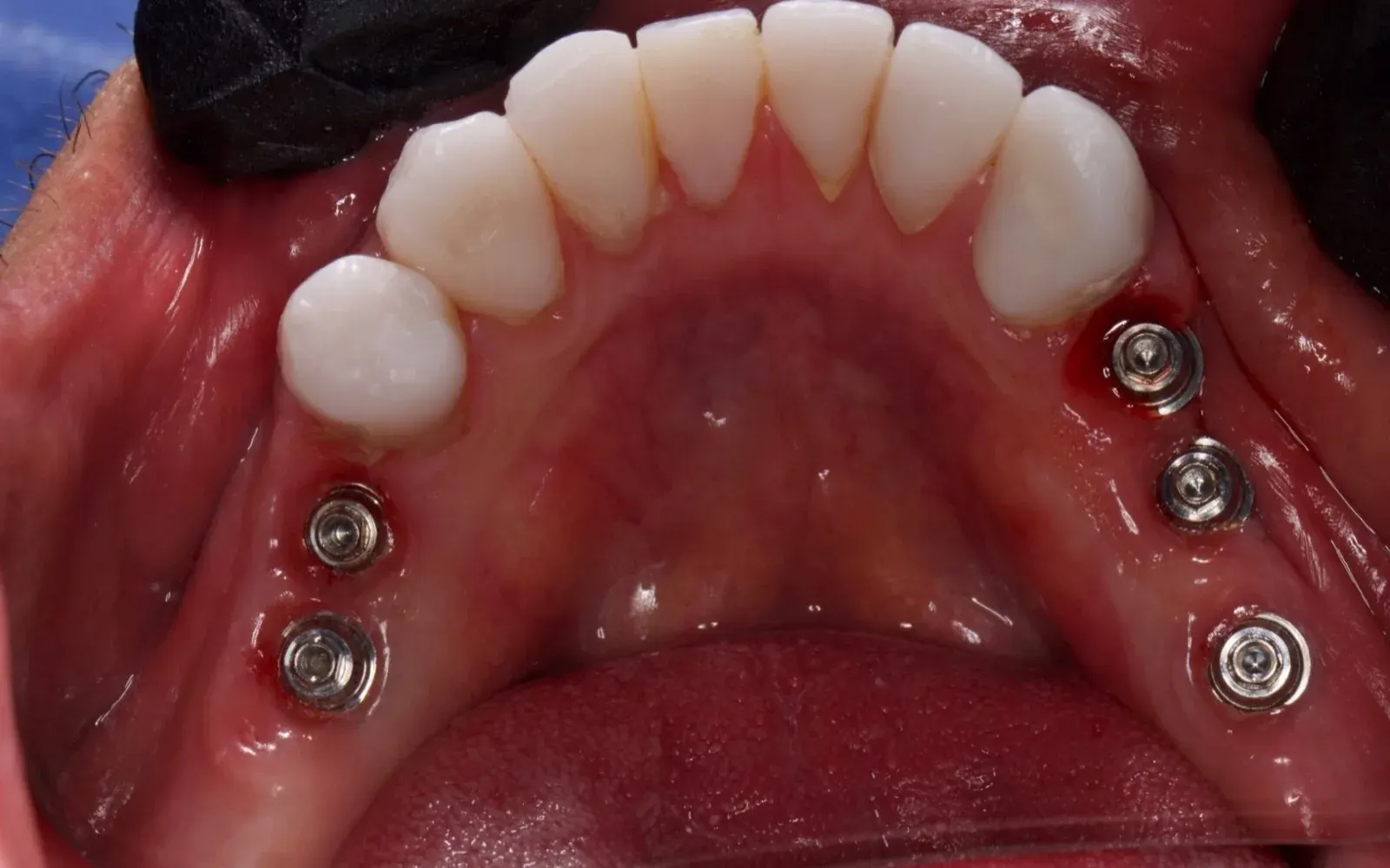 Rehabilitación sobre implantes: antes del tratamiento