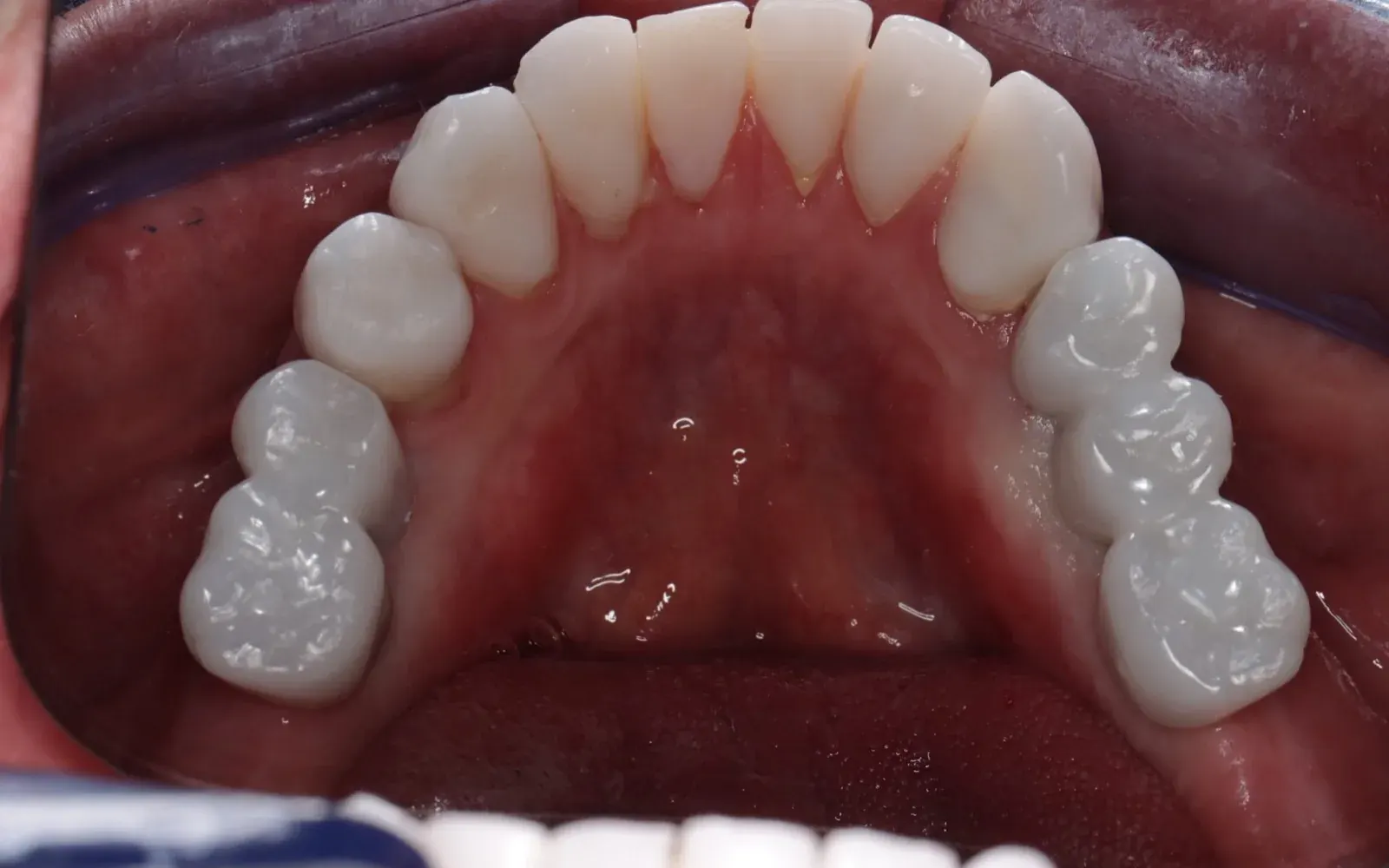 Rehabilitación sobre implantes: después del tratamiento