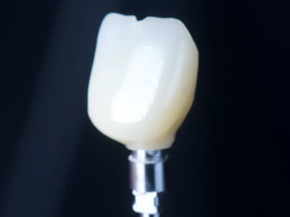 Corona de porcelana sobre un implante dental
